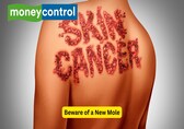 Skin cancer and sun exposure: 10 symptoms, risks and prevention tips