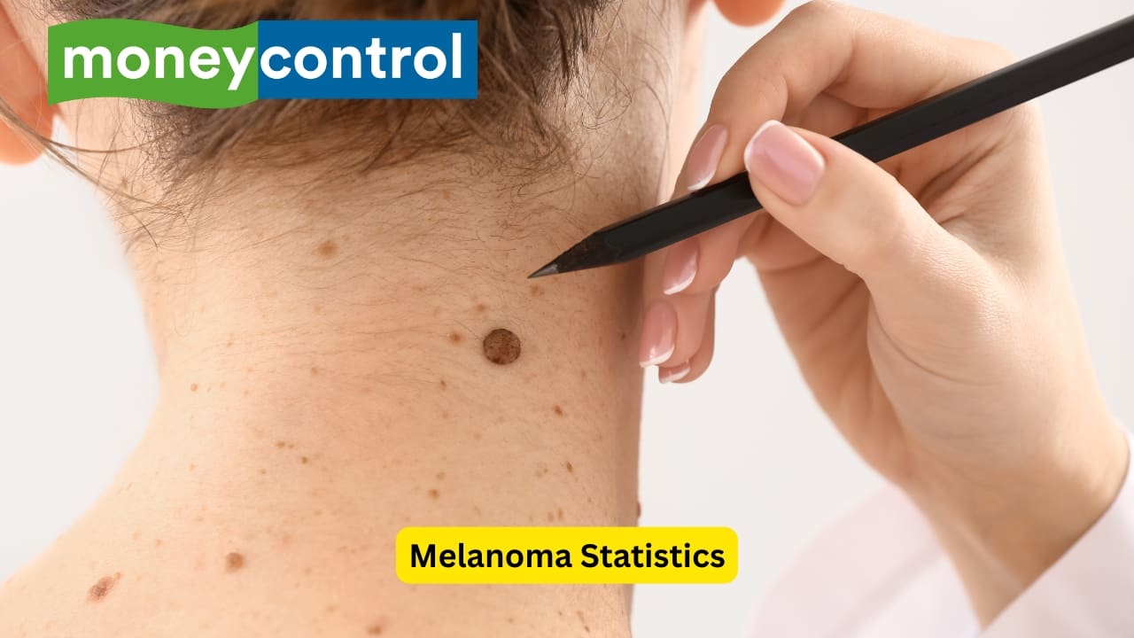  Melanoma Statistics According to global data from GLOBOCAN 2022, India reported over 1.4 million new cancer cases, with melanoma of the skin accounting for just 0.26% (around 3,689 cases). While skin cancer rates remain relatively low, early detection and awareness are still essential.(Image: Canva)