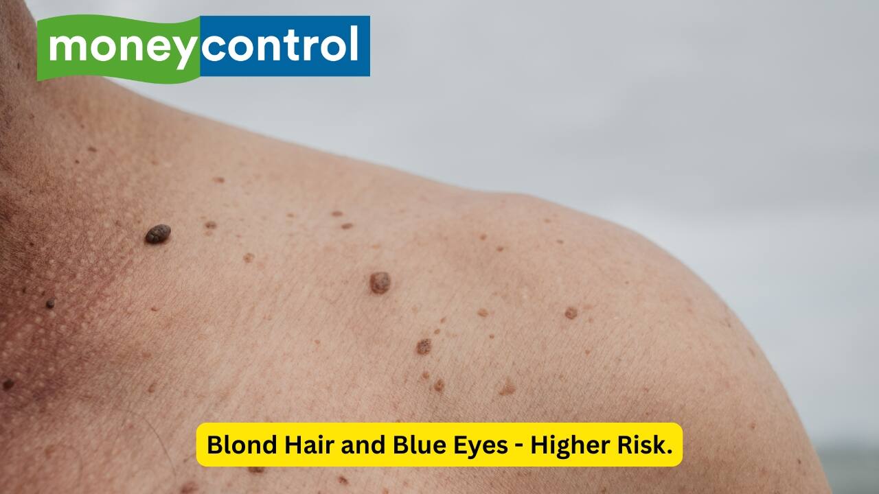Blond Hair and Blue Eyes - Higher Risk. Though people with lighter skin, red or blond hair, green or blue eyes, or a history of sunburns carry higher risks, skin cancer can happen to anyone. It develops in the outermost layer of the skin—the epidermis—specifically in basal, squamous, or melanocyte cells. And while basal and squamous cell cancers are treatable, melanoma—the deadliest form—spreads quickly and can be fatal if caught too late.(Image: Canva)
