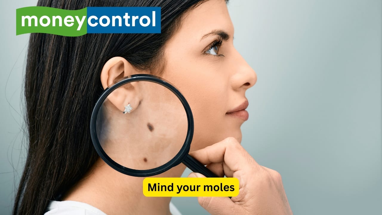 Mind your moles Have many moles or unusual ones? Get them checked regularly, as any changes in shape, size or colour can be early warning signs of skin cancer. Contact your healthcare provider if your mole begins to ulcerate, or undergoes any sudden change in its morphology.(Image: Canva) Disclaimer: This article, including health and fitness advice, only provides generic information. Don’t treat it as a substitute for qualified medical opinion. Always consult a specialist for specific health diagnosis