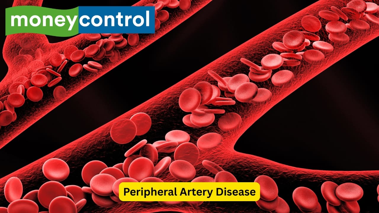 Diagnosis and Tests The blood pressure is measured at multiple levels of the limb to determine which arteries have been affected. A complete blood count is also advised, and reduced levels of haemoglobin may delay healing as enough oxygen does not reach the tissues. A test for diabetes may also be done, as diabetes can increase the chances of infection.(Image: Canva) Disclaimer: This article, including health and fitness advice, only provides generic information. Don’t treat it as a substitute for qualified medical opinion. Always consult a specialist for specific health diagnosis
