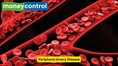 Peripheral artery disease: Why your calf muscles may be paining