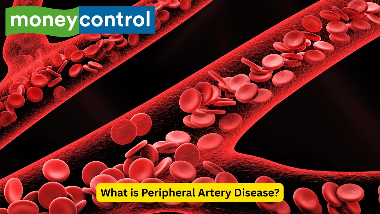 What is Peripheral Artery Disease? A condition of the blood vessels where they become narrowed, thus reducing the amount of blood reaching the limbs, is known as peripheral artery disease. It can be due to multiple reasons that cause symptoms like crampy pain. Plaque buildup is usually the reason for this.(Image: Canva)