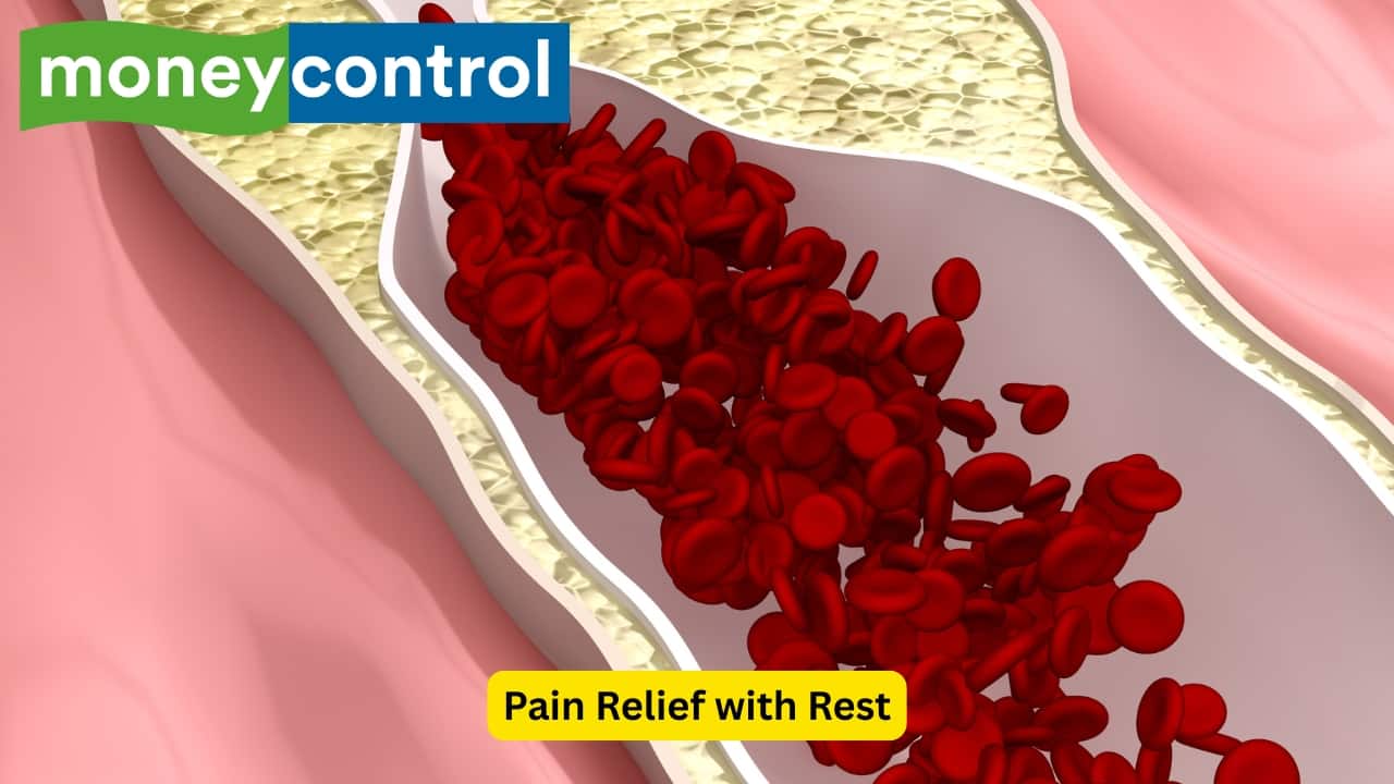 Pain Relief with Rest In severe cases, the affected individual may need to rest to relieve pain. Pain while walking may be present in many cases, and the underlying cause may be arterial, neurogenic or venous. In arterial causes, the pain resolves quickly (within five minutes), once the person stops walking.(Image: Canva)   
