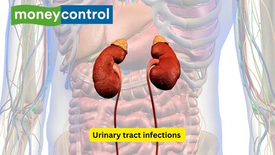 10 things to know about urinary tract infections: Causes, symptoms, treatment and more