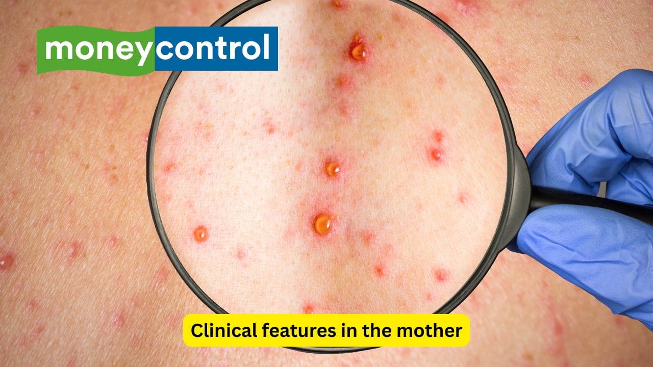 How rubella infection affects pregnancy: Causes, complications, and ...