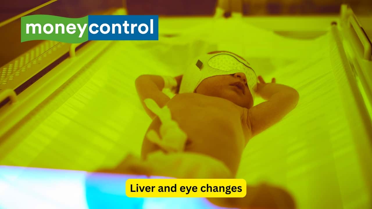Liver and eye changes The liver and the spleen may also get affected, leading to an increase in their size. Jaundice may be seen in the baby in some cases. The eyes of the foetus may show changes of cataract and retinopathy, along with a cloudiness of the cornea.(Image: Canva)