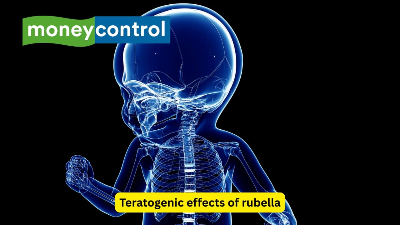  Teratogenic effects of rubella The virus mostly affects the foetus and is extremely teratogenic (anything that causes an interruption in the normal development of the baby in the mother’s womb), especially during the first three months. Bone defects like osteopathies are also seen due to infection of the foetus by Rubella.(Image: Canva)