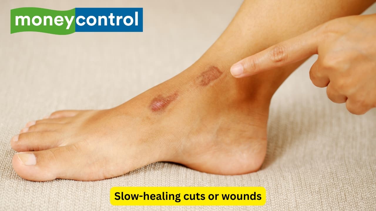 Slow-healing cuts or wounds If your feet take longer to recover from small cuts, you may not be getting enough vitamin C, zinc or protein — all of which are important in tissue repair. Poor healing in wounds may also lead to increased risk of contracting infection. Foods like citrus fruits, seeds, lean meats and legumes can all help in promoting skin regeneration.(Image: Canva)