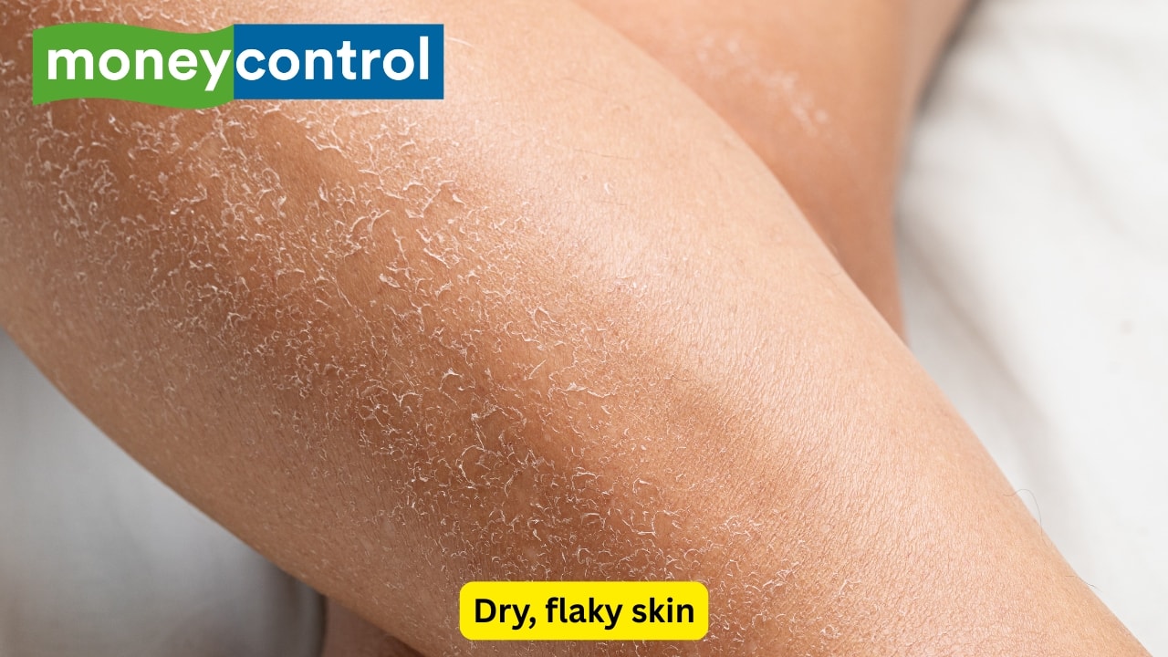 Dry, flaky skin If your skin is constantly dry, it could be an indicator of not enough vitamin A, vitamin E, or omega-3 fatty acids in your diet – which helps keep the skin moist. Dry skin may also crack and be irritated or itchy. Foods like fish, nuts, seeds, and colorful vegetables will all help restore hydration to the skin.(Image: Canva)