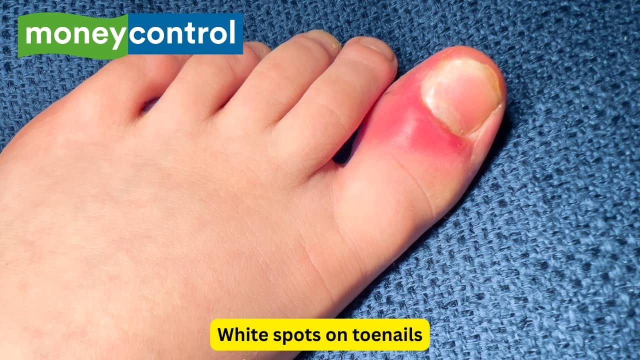 White spots on toenails Zinc is a key nutrient for growth and repair of the nails, so these spots are often associated with the mineral deficiency. These can also develop after a minor injury to the nail bed. Eating more pumpkin seeds, legumes (beans and peas) and whole grains may help reduce this issue.(Image: Canva)