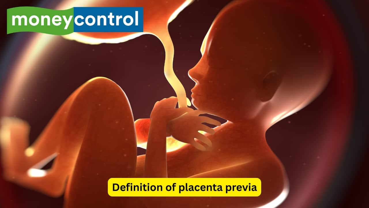 Definition of placenta previa When the placenta becomes implanted over the lower uterine segment, either completely or partially, it is known as placenta previa. Almost one third of the people who experience antepartum haemorrhage usually have placenta previa also. In almost 80% of cases, it is seen in women who have had multiple pregnancies.(Image: Canva) Definition of placenta previa When the placenta becomes implanted over the lower uterine segment, either completely or partially, it is known as placenta previa. Almost one third of the people who experience antepartum haemorrhage usually have placenta previa also. In almost 80% of cases, it is seen in women who have had multiple pregnancies.(Image: Canva)