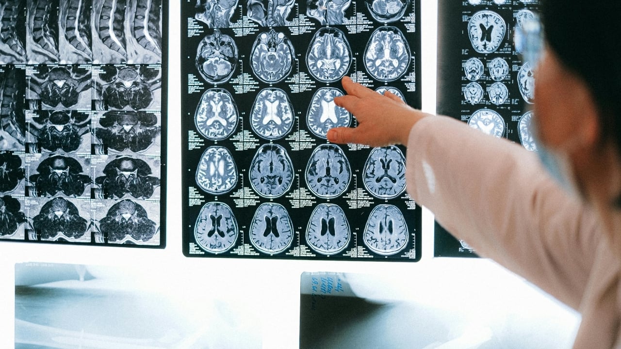 Is DMT the future of stroke care? New research suggests it boosts brain healing