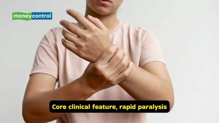 Guillain-Barré Syndrome causes, symptoms and treatment options (Image: Canva)