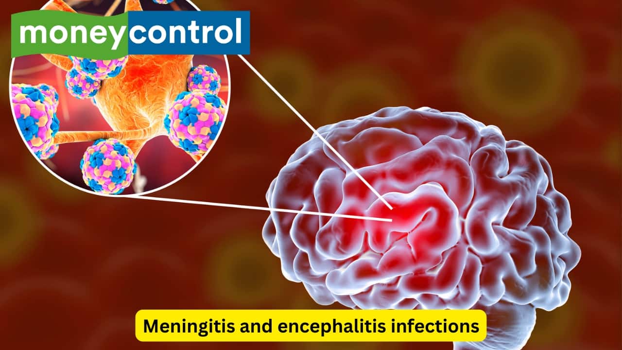 Meningitis and encephalitis infections The outer coverings of the brain, known as the meninges, may also get infected (meningitis). Some pathogens have the ability to affect the brain parenchyma as well (encephalitis). The affected individual experiences an acute onset of fever with headache and neck stiffness. Altered mental status may also be seen. (Image: Canva)