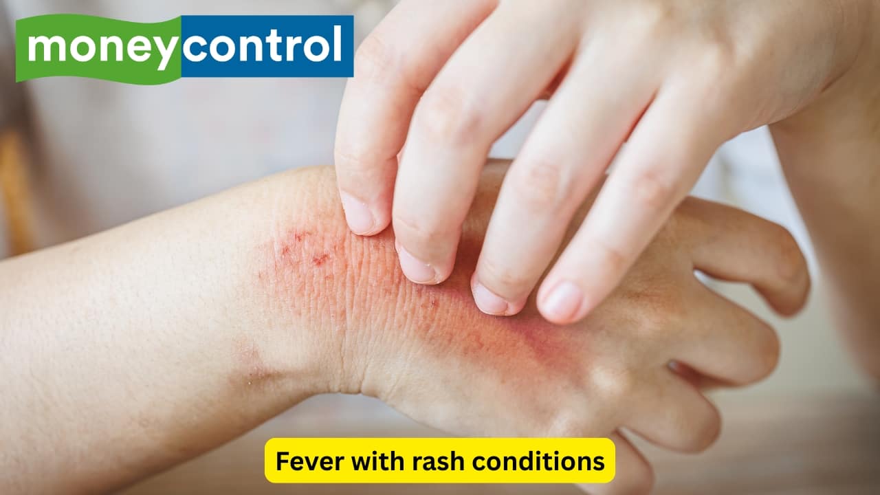 Fever with rash conditions There are some kinds of fever that present with a rash. This can occur because of conditions like measles, meningococcemia, scarlet fever, and drug reactions. It is necessary to find the underlying cause by assessing the pattern and timing of fever. Some pathognomonic signs like Koplik spots (seen in measles) can help cinch the diagnosis. (Image: Canva)