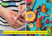 Diwali safety tips: Plastic surgeon on what you should do when there is a burn injury