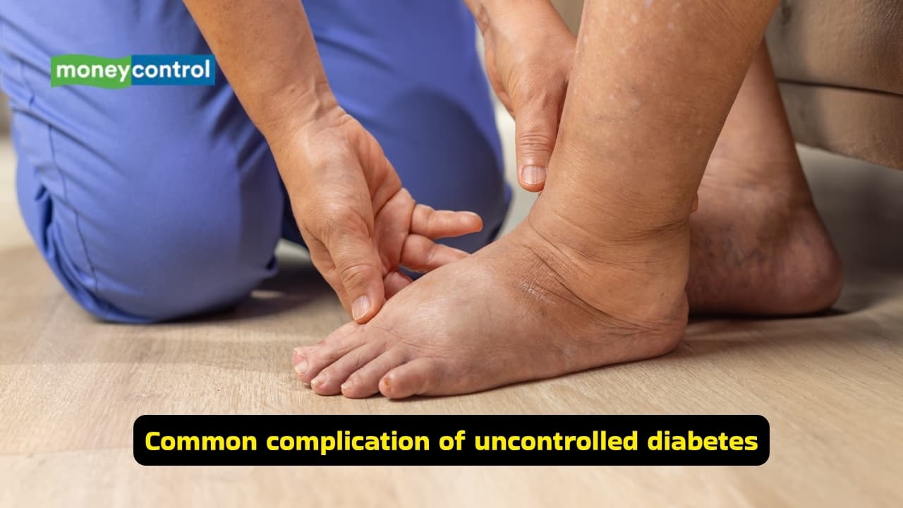 Symptoms of Diabetic Foot and causes (Images: Canva)
