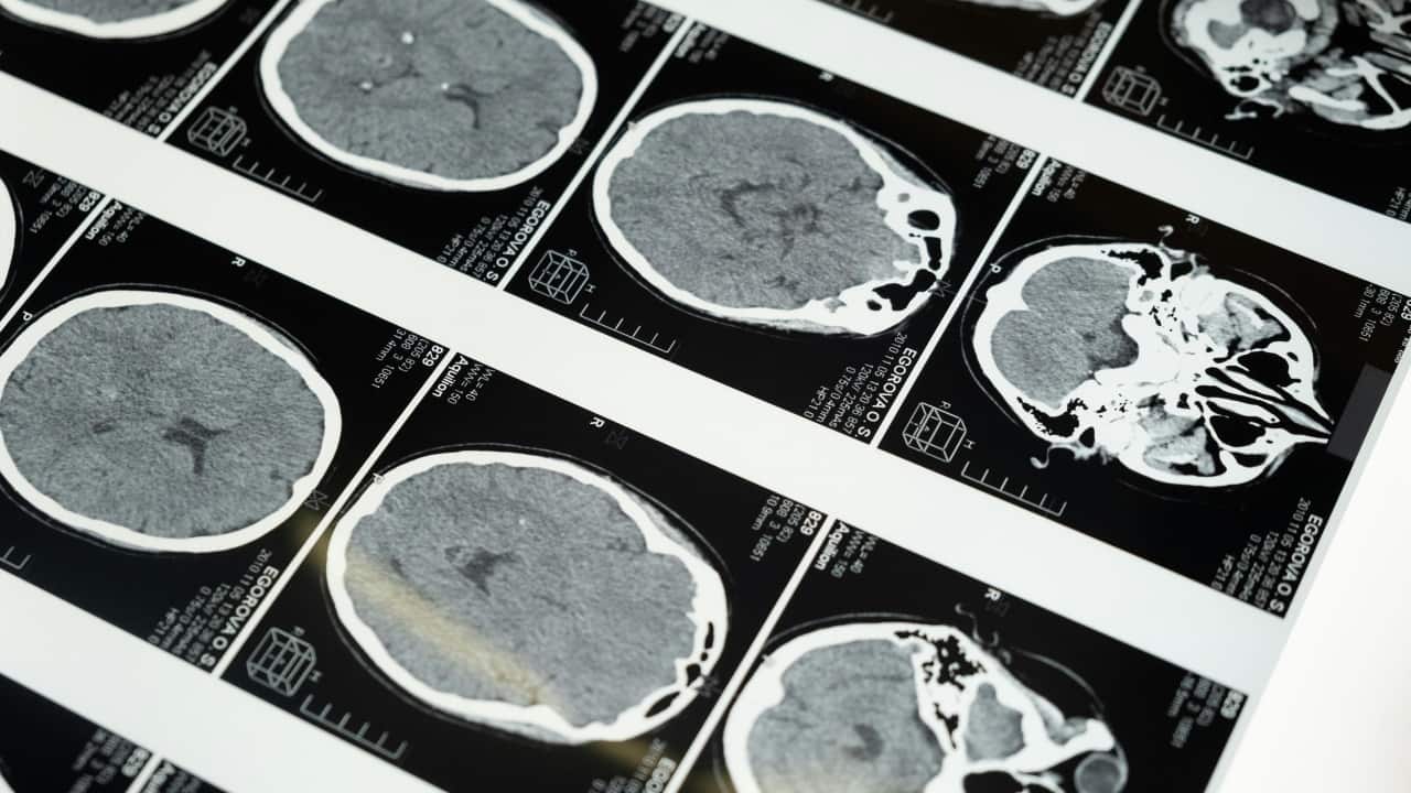 Mini-strokes in your 30s: How late nights and caffeine could be harming you