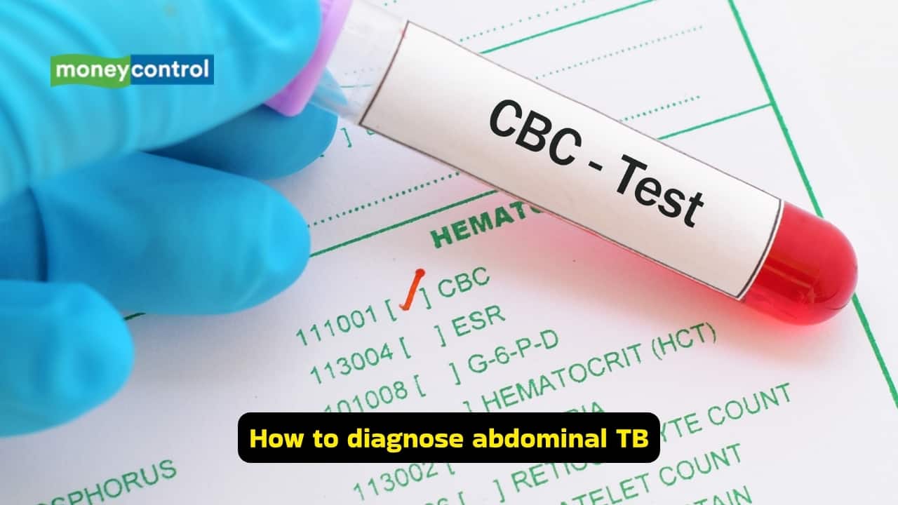 Causes and symptoms of abdominal TB (Image: Canva)