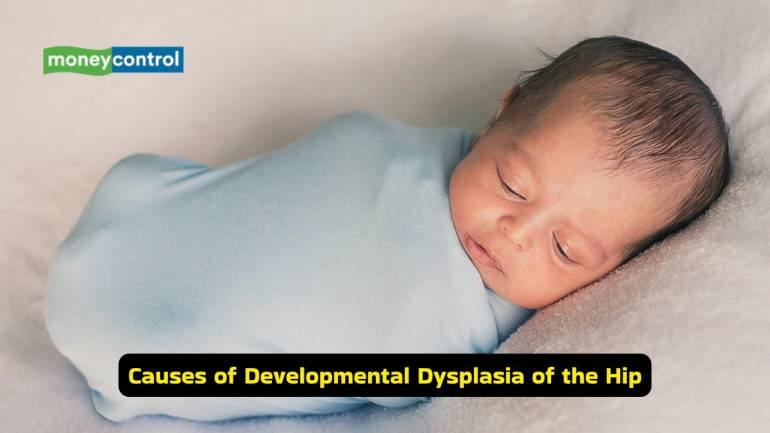 What is Developmental Dysplasia of the Hip (Image: Canva)