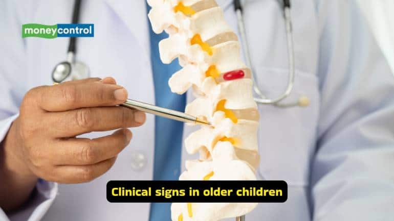What is Developmental Dysplasia of the Hip (Image: Canva)