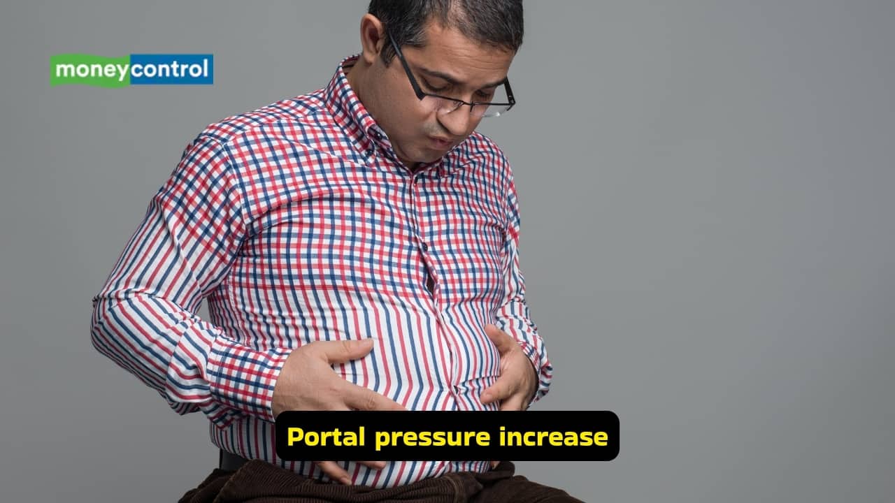 Ascites: Causes, symptoms, and best treatment options (Image: Canva)