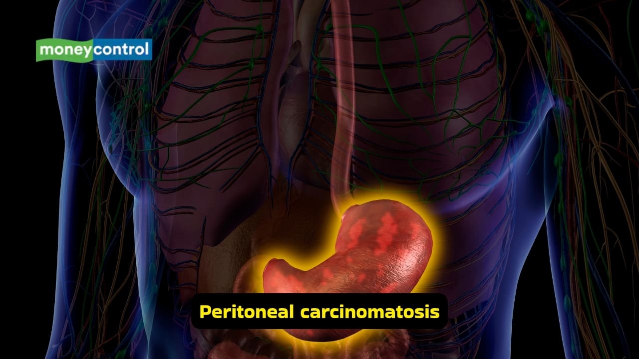 Ascites: Causes, symptoms, and best treatment options (Image: Canva)