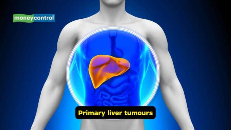 Ascites: Causes, symptoms, and best treatment options (Image: Canva)