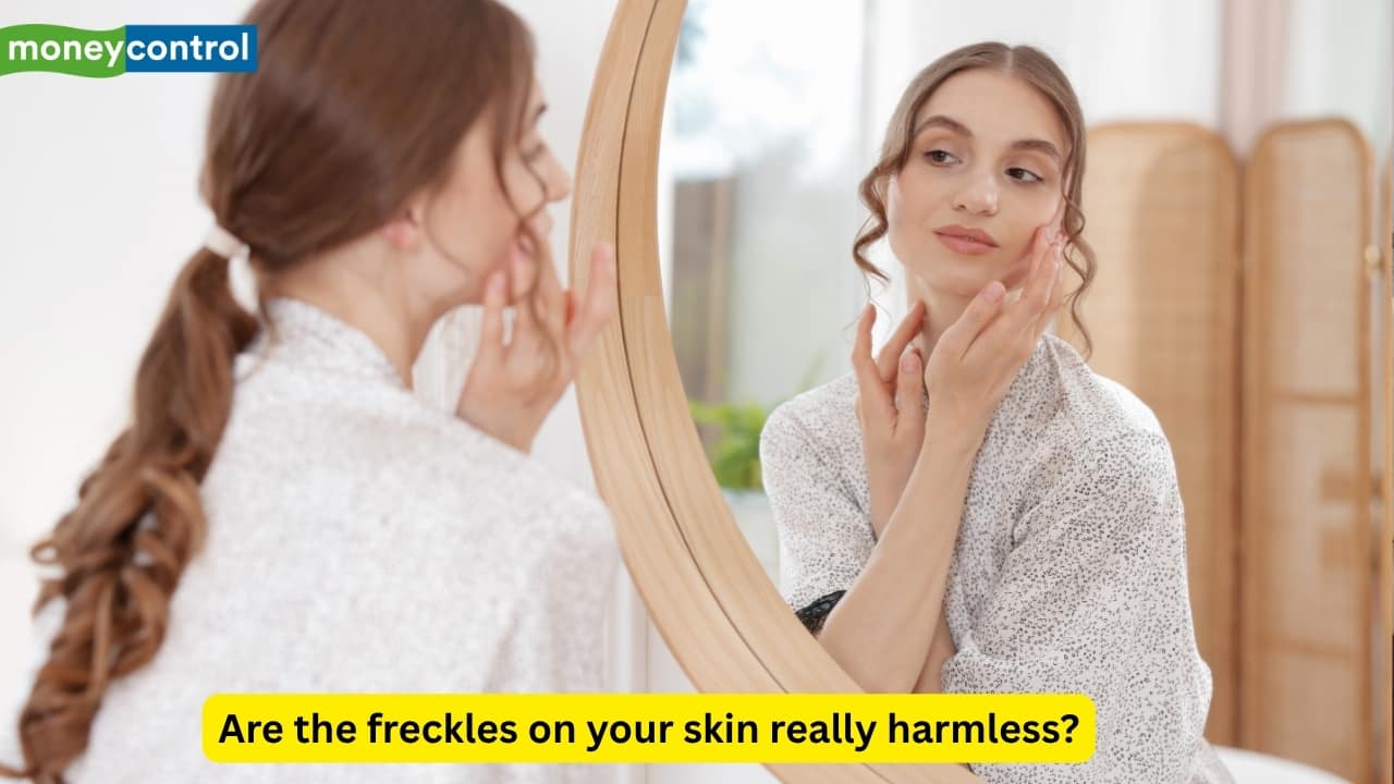 National cancer awareness day: Doctor warns not to ignore freckles and sores on your skin; Here's why National cancer awareness day: Doctor warns not to ignore freckles and sores on your skin; Here's why