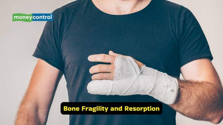 Osteoporosis Causes, symptoms, and prevention tips for stronger bones (Image: Canva)