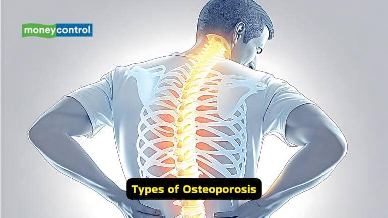 Osteoporosis Causes, symptoms, and prevention tips for stronger bones (Image: Canva)