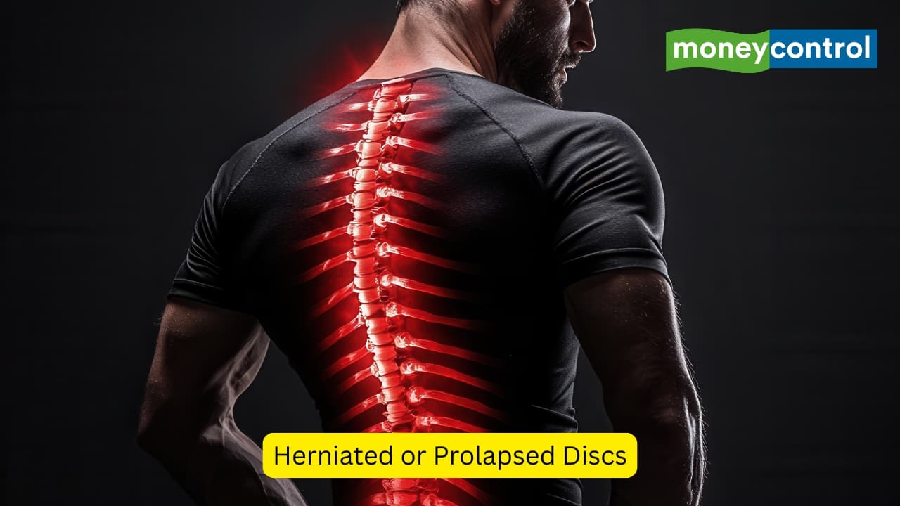 Herniated or Prolapsed Discs On some occasions, the intervertebral discs (present between two vertebrae) may begin to protrude. This is known as a prolapsed intervertebral disc or a herniated disc, and can cause radiating pain in the lower limbs, along with numbness and weakness. (Image: Canva)
