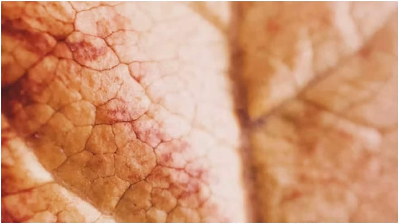 Chinese woman develops 'snake skin' after using 'herbal' ointment for a decade