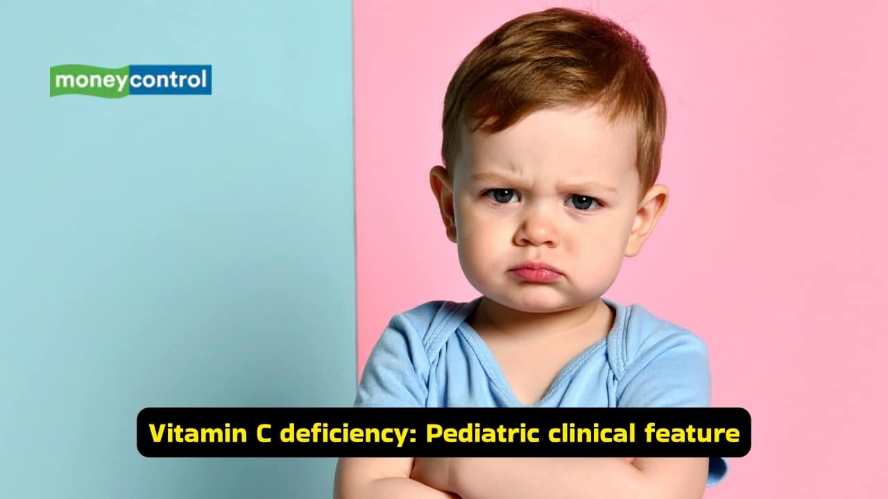 <strong>Vitamin C deficiency: Pediatric clinical features</strong><br />Children with vitamin C deficiency present with irritability and limb pain. Gum hypertrophy is also a common feature of scurvy. Impaired collagen causes weakness in the bones, and if haemorrhages develop, severe bone pain can be experienced. The risk of fractures increases as well.