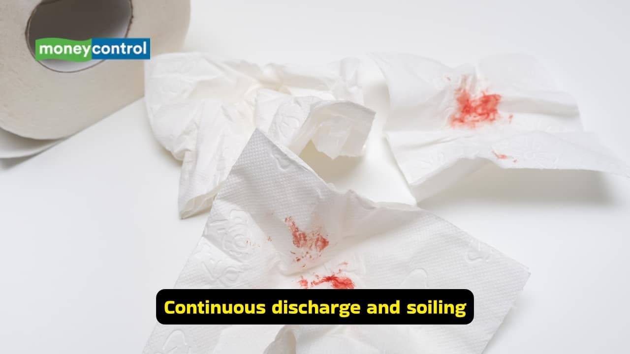 <strong>Continuous discharge and soiling</strong><br />Persistent discharge of pus or serous fluid from the external opening can soil the person’s undergarments, a common complaint of affected individuals. They may also notice intermittent swelling and pain, that worsens during defecation.