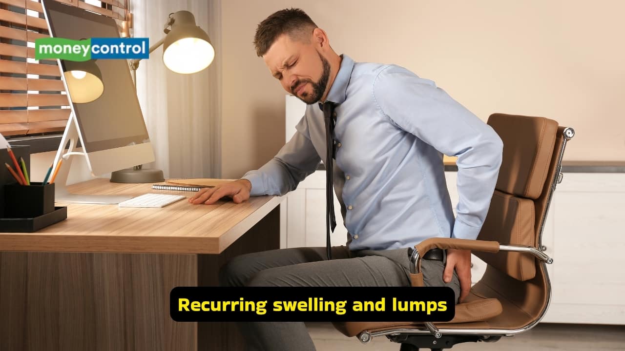 <strong>Recurring swelling and lumps</strong><br />Perianal swelling or a tender lump that keeps appearing and receding is also a typical feature of anal fistula. This usually occurs due to an underlying abscess, and if left untreated, can cause fibrosis. Early drainage, hence, becomes necessary.