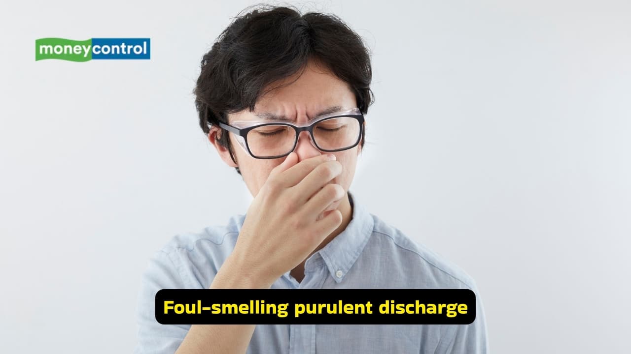<strong>Foul-smelling purulent discharge</strong><br />The discharge from an anal fistula is often foul-smelling, and is observed in people who have had long-standing fistulae, and it occurs because of infection by anaerobic organisms (organisms that do not need oxygen to survive). The nature of the discharge may aid in identifying the severity.