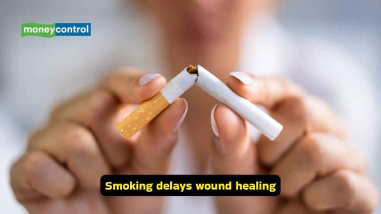 <strong>Smoking delays wound healing</strong><br />Smoking has also been known to delay wound healing, and must be avoided. Nicotine, present in cigarettes, can cause vasoconstriction and also reduce oxygenation in tissues. Cessation of smoking improves healing and may reduce the risk of developing complex fistula tracts.