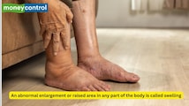 From lipoma to abscess, know all about different types of swelling