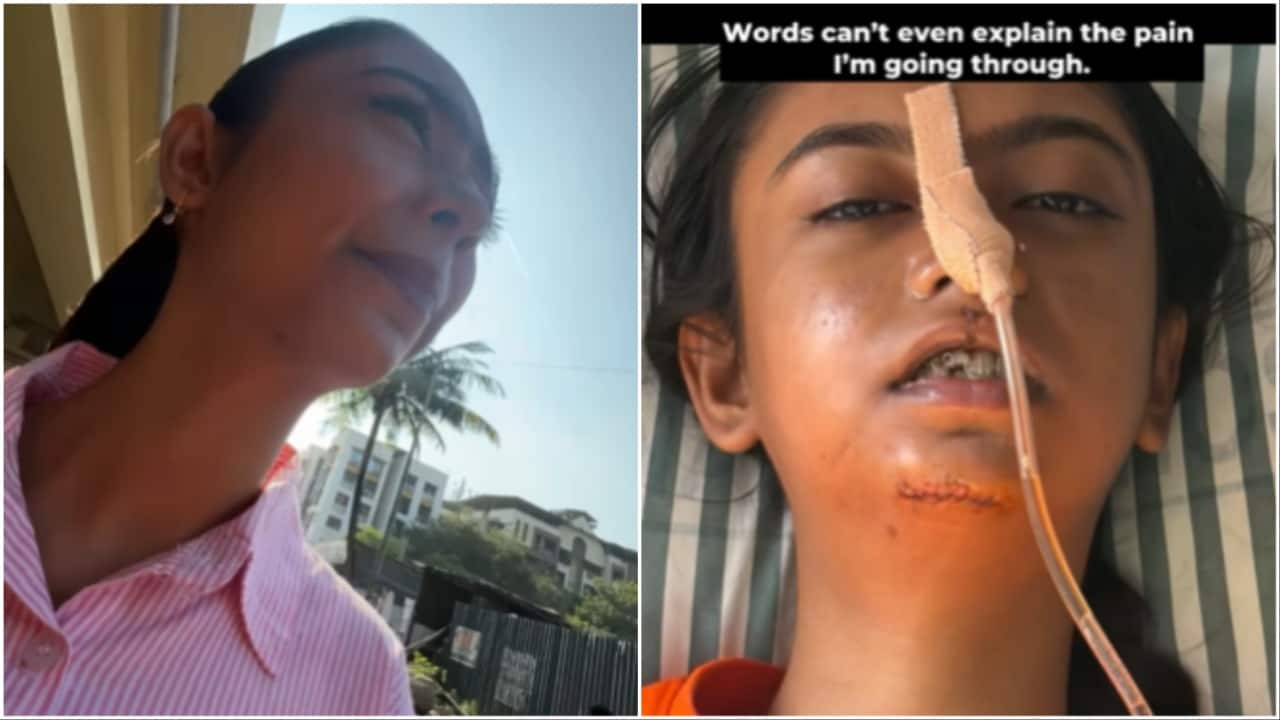 Mumbai YouTuber injured during Rapido ride, has jaw, chin surgery. Company responds