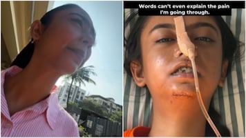Mumbai YouTuber meets with accident during Rapido ride, has jaw, chin surgery. Company responds