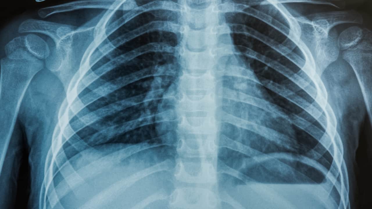 <strong>Diagnostic approaches used</strong><br />A chest X-ray and an HRCT can aid in identifying chronic obstructive pulmonary disease. The treatment often includes bronchodilators and inhaled corticosteroids. Proper technique while using the inhaler is crucial for adequate effect of the drugs. (Picture Credit: Canva)