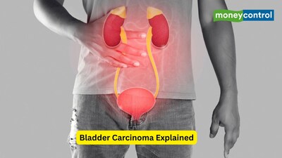 Bladder carcinoma often presents with painless blood in urine. Learn how smoking, chemical exposure and chronic irritation raise risk, symptoms and treatment. (Image: Canva)