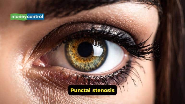 Causes, symptoms and treatment tips for epiphora (Images: Canva) Causes, symptoms and treatment tips for epiphora (Images: Canva)