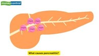 <strong>Severity and Major Causes</strong><br />Depending upon severity, it may either be mild and self-limiting, or may progress to severe and life-threatening diseases. One of the most common causes of acute pancreatitis is the presence of gallstones. Long-term consumption of alcohol is also one of the leading causes of<br />acute pancreatitis. (Picture Credit: Canva)