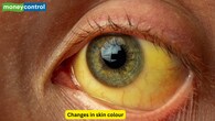 <strong>Skin Changes and Lab Markers</strong><br />Changes in the skin of the flank area and discolouration near the belly button. When the cause is biliary obstruction, jaundice may be seen as well. Serum amylase and lipase are known to key markers for identifying pancreatitis. Lipase is more specific, and the liver function test may be advised as well. (Picture Credit: Canva)