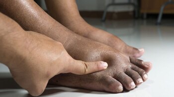 Swelling of the feet and ankles occurs when excess fluid accumulates in the tissues due to heart, liver, kidney or venous problems (Image: Pinterest)