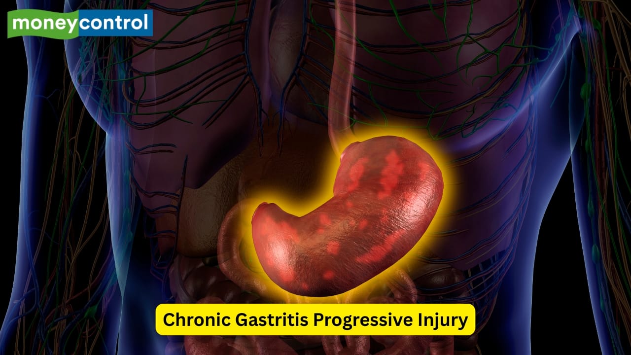 Chronic Gastritis Progressive Injury Long-term gastritis is caused due to persistent infection by Helicobacter pylori. Chronic injury to the gastric muscles leads to mucosal atrophy and loss of the glands present in the stomach. Such changes lead to a reduced production of the intrinsic factor, which in turn increases the risk of vitamin B12 deficiency. (Image: Canva) Chronic Gastritis Progressive Injury Long-term gastritis is caused due to persistent infection by Helicobacter pylori. Chronic injury to the gastric muscles leads to mucosal atrophy and loss of the glands present in the stomach. Such changes lead to a reduced production of the intrinsic factor, which in turn increases the risk of vitamin B12 deficiency. (Image: Canva)