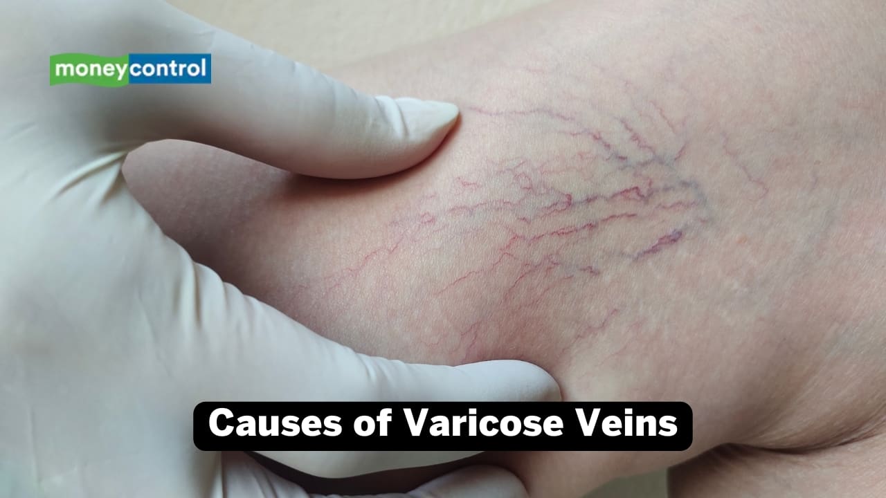 Causes, symptoms and ways to treat varicose veins: Keep your legs elevated while sleeping for relief